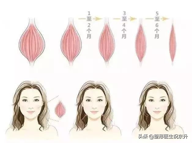 打了三次瘦脸针想告诉你这些真相,刚打了瘦脸针后悔了有补救吗
