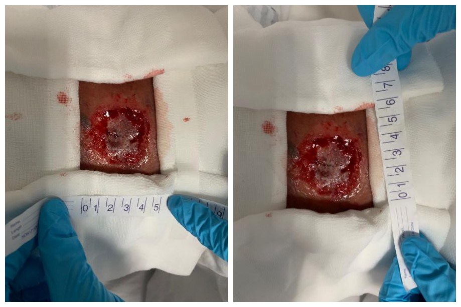 光动力肿瘤治疗进展,光动力治疗能完全去除肿瘤吗