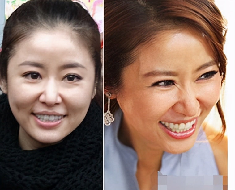 面部法令纹显老怎么改善,法令纹显老10岁三种方法帮助缓解