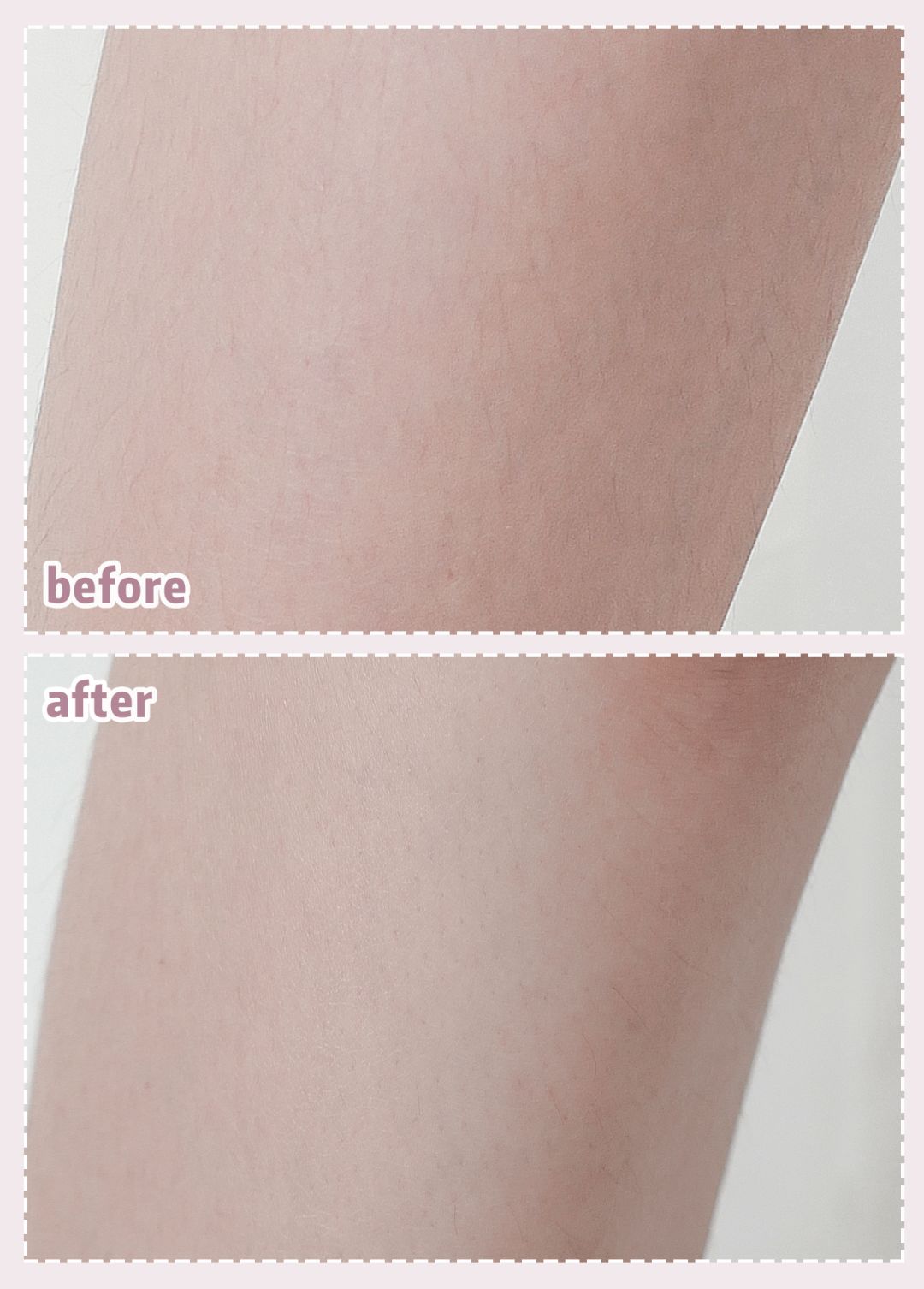 体毛脱毛的效果怎么样,天生体毛旺盛的人正常吗