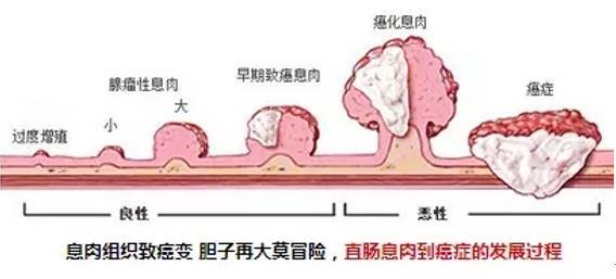 息肉演变的癌能治吗,息肉癌变的原因和治疗方法