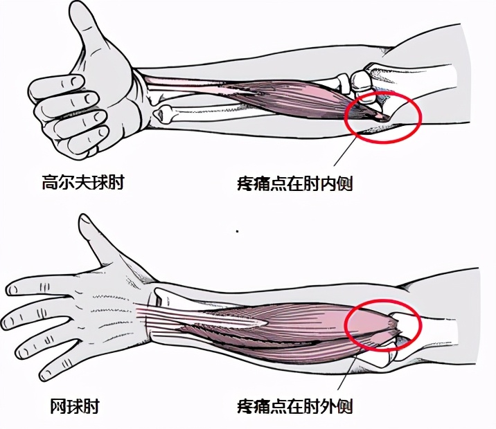 肘关节内侧疼痛的原因和治疗方法,肘关节内侧疼痛引起小手指麻