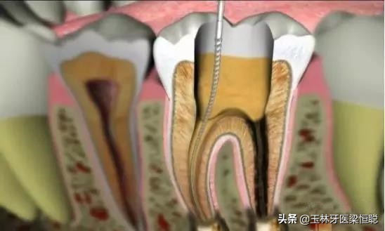 牙坏了医生说保不住为什么不给拔,牙崩了一半怎么补牙