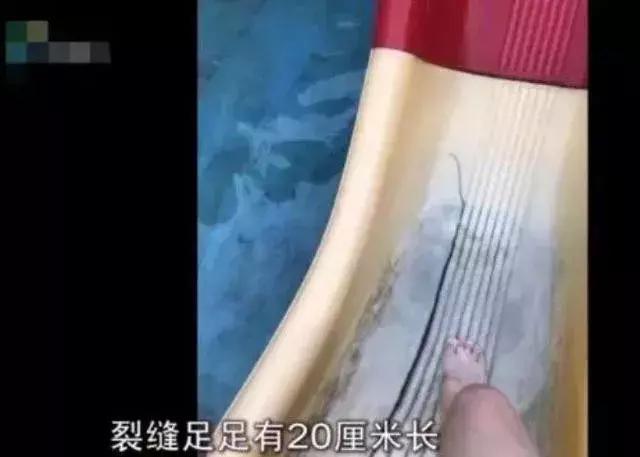 孩子在滑滑梯头朝下滑导致骨折,小孩玩滑梯骨折了怎么办