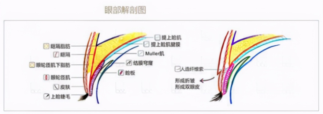 双眼皮宽深修复后三眼皮案例,埋线双眼皮过宽如何修复