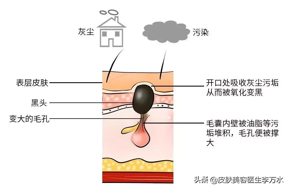 真假黑头教你如何正确去黑头,去黑头小妙招你的黑头有救了