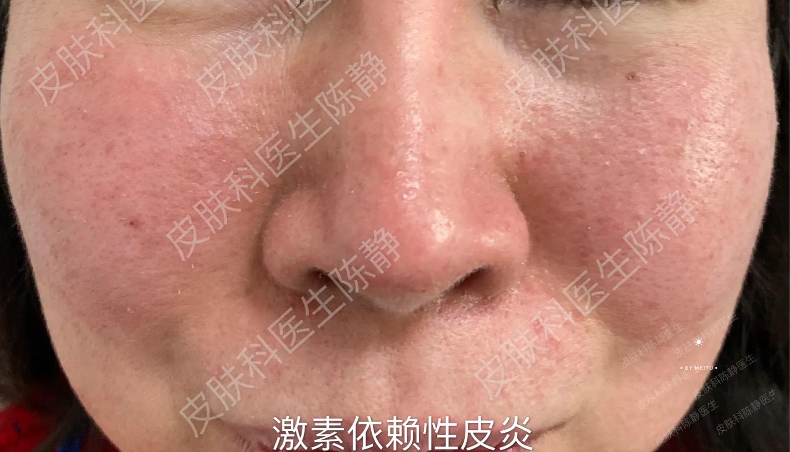 过敏脸上身上全是红痘痘,脸红就是玫瑰痤疮吗