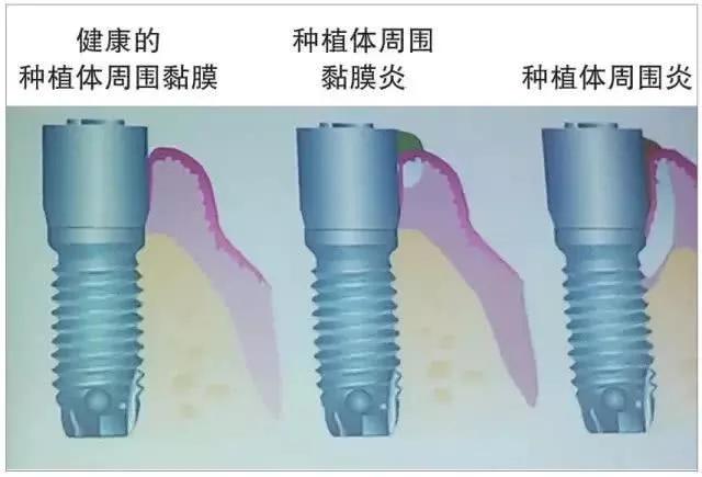 牙周病拔了全部的牙,牙周炎牙齿拔掉就好了吗