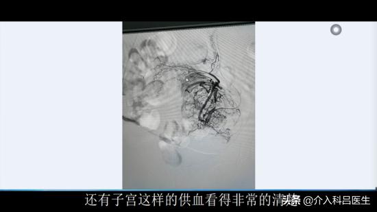 子宫肌瘤不想做腹腔镜怎么办,子宫肌瘤切除微创手术