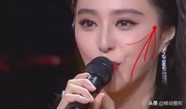 28岁做线雕提升脸部好不好,28岁女人做线雕现状