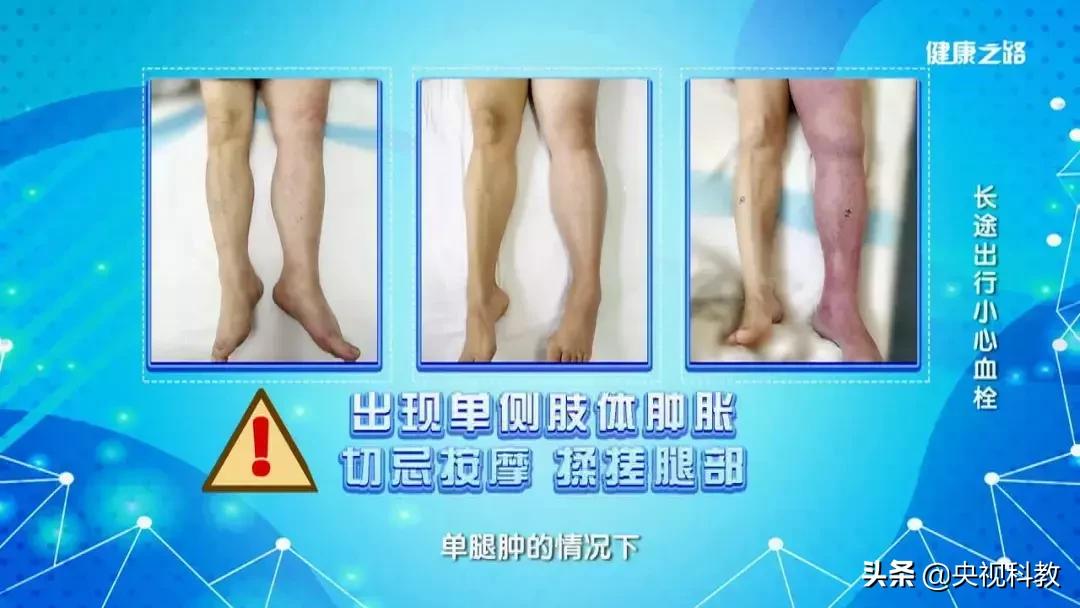 这4类人需尤其当心,肺栓塞会猝死吗