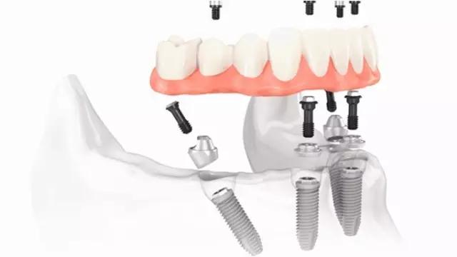 种植牙牙齿缺失最好的修复方案,半口种植牙即刻修复多久能吃东西