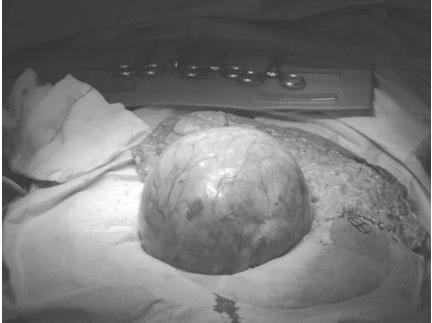 直肠癌晚期手术病例,直肠癌晚期多发性肠梗阻