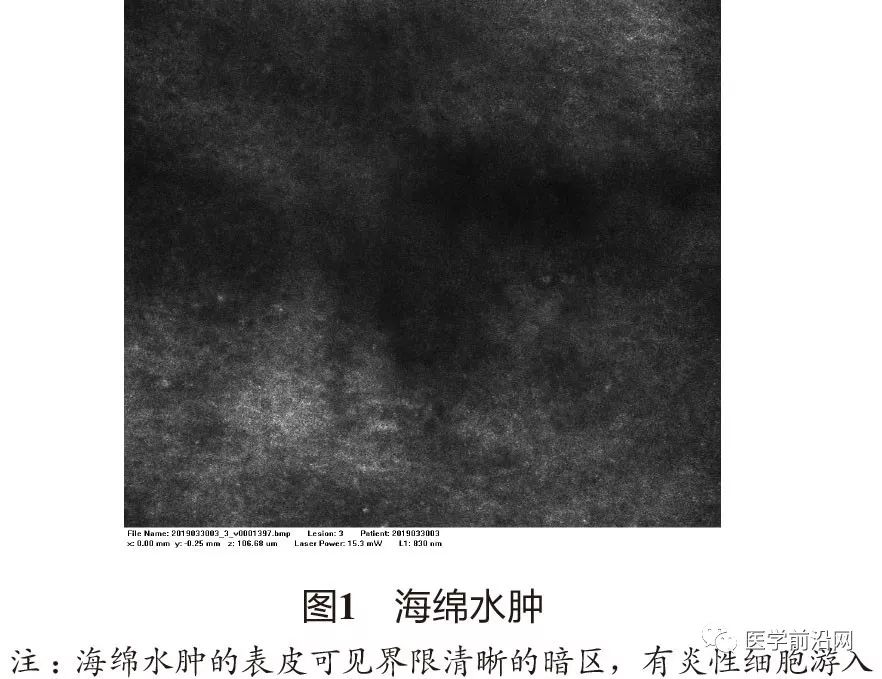 炎症性皮肤病反射式共聚焦显微镜诊断特征专家共识全文发布