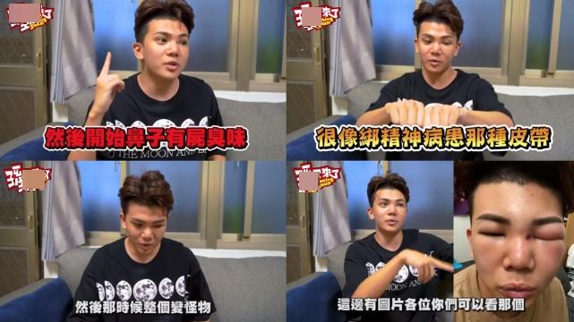 隆鼻失败网红取假体,网红整容鼻子失败案例