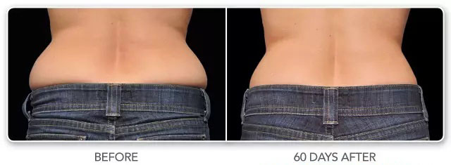 酷塑冷冻溶脂副作用是什么样的,酷塑冷冻溶脂的真实经历对比