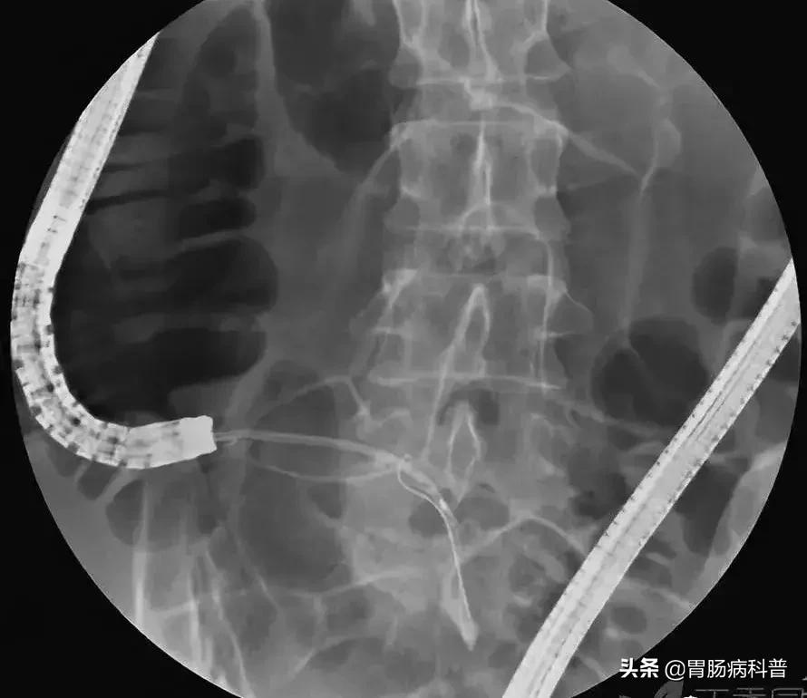 阑尾炎最新内镜微创手术,内镜下阑尾炎治疗术哪里可以做