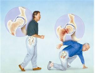 滑膜炎骨刺骨质增生怎么治,膝盖骨质增生长骨刺怎么治