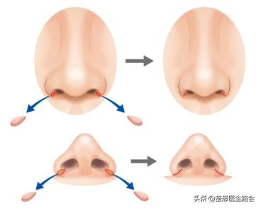 鼻翼缩小和鼻翼缩小之后的对比,超有效的缩小鼻翼的方法