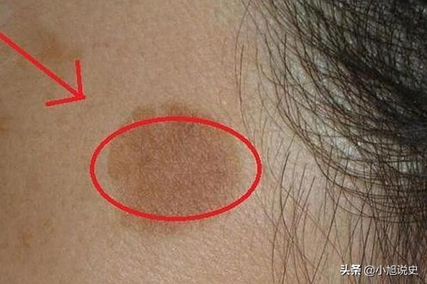 脸上有个褐斑越来越大怎么办,脸上长了褐斑越来越大