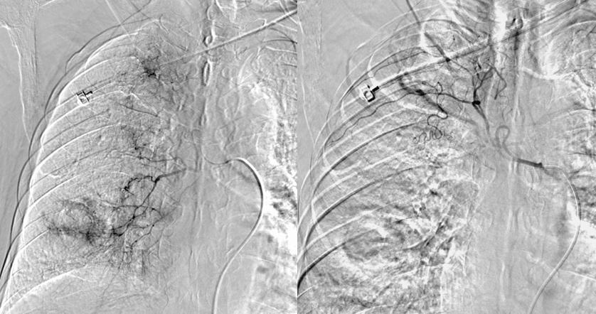 肺鳞癌介入治疗成功率,肺鳞癌最好的免疫化疗方案