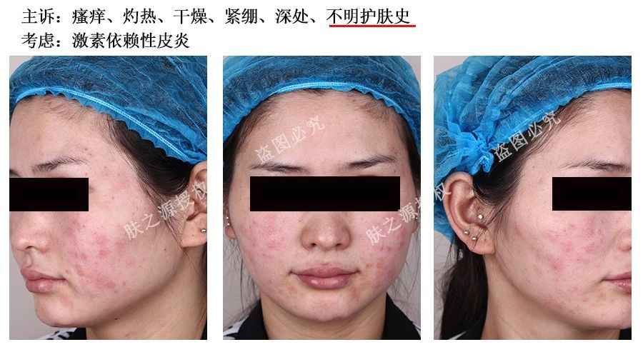 皮肤科激素依赖性皮炎,皮肤科名医激素依赖性皮炎