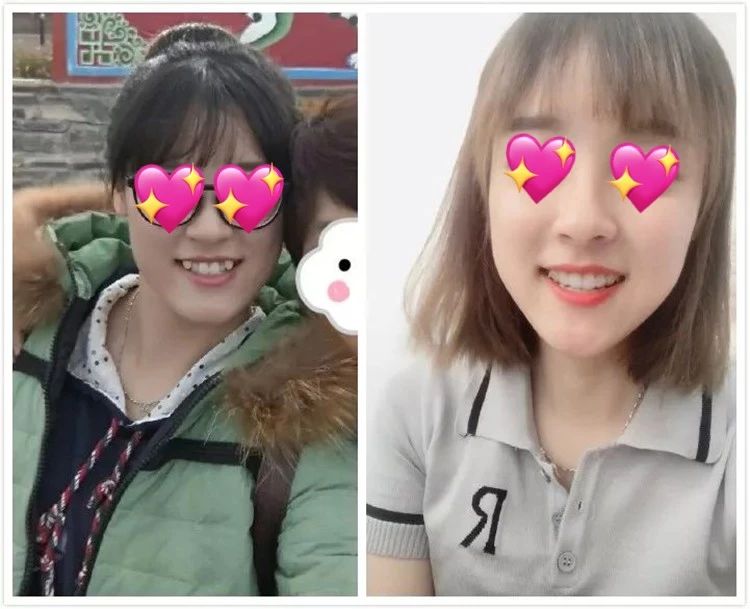 整牙齿堪比整容,矫正牙齿大概多少钱龅牙