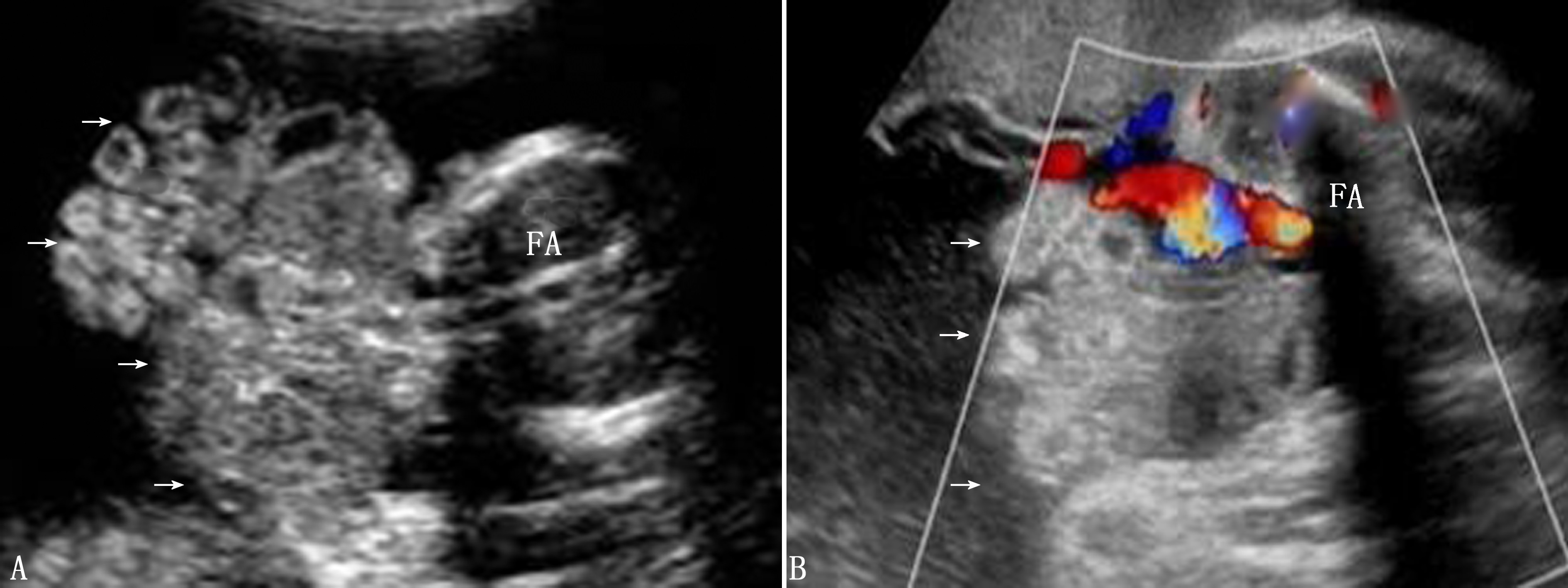 明明白白做超声28-12：前腹壁异常