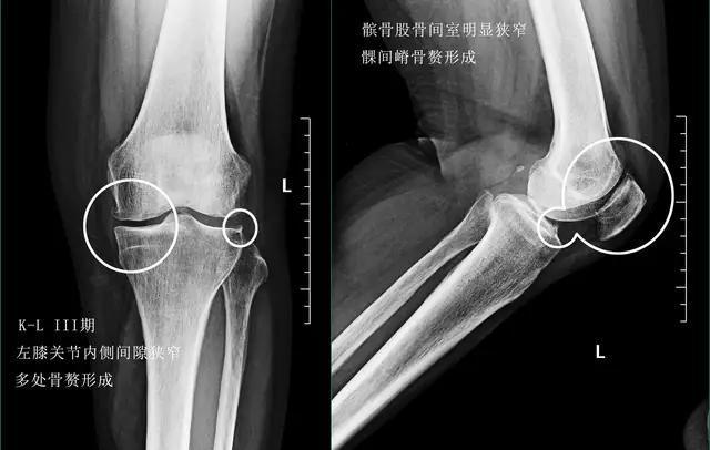 老人膝盖疼平时应怎么样康复锻炼,老年人膝盖后面肌肉疼痛怎么回事