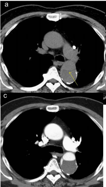 胸部Ct平扫能查出主动脉夹层吗,主动脉夹层cta影像图片解读