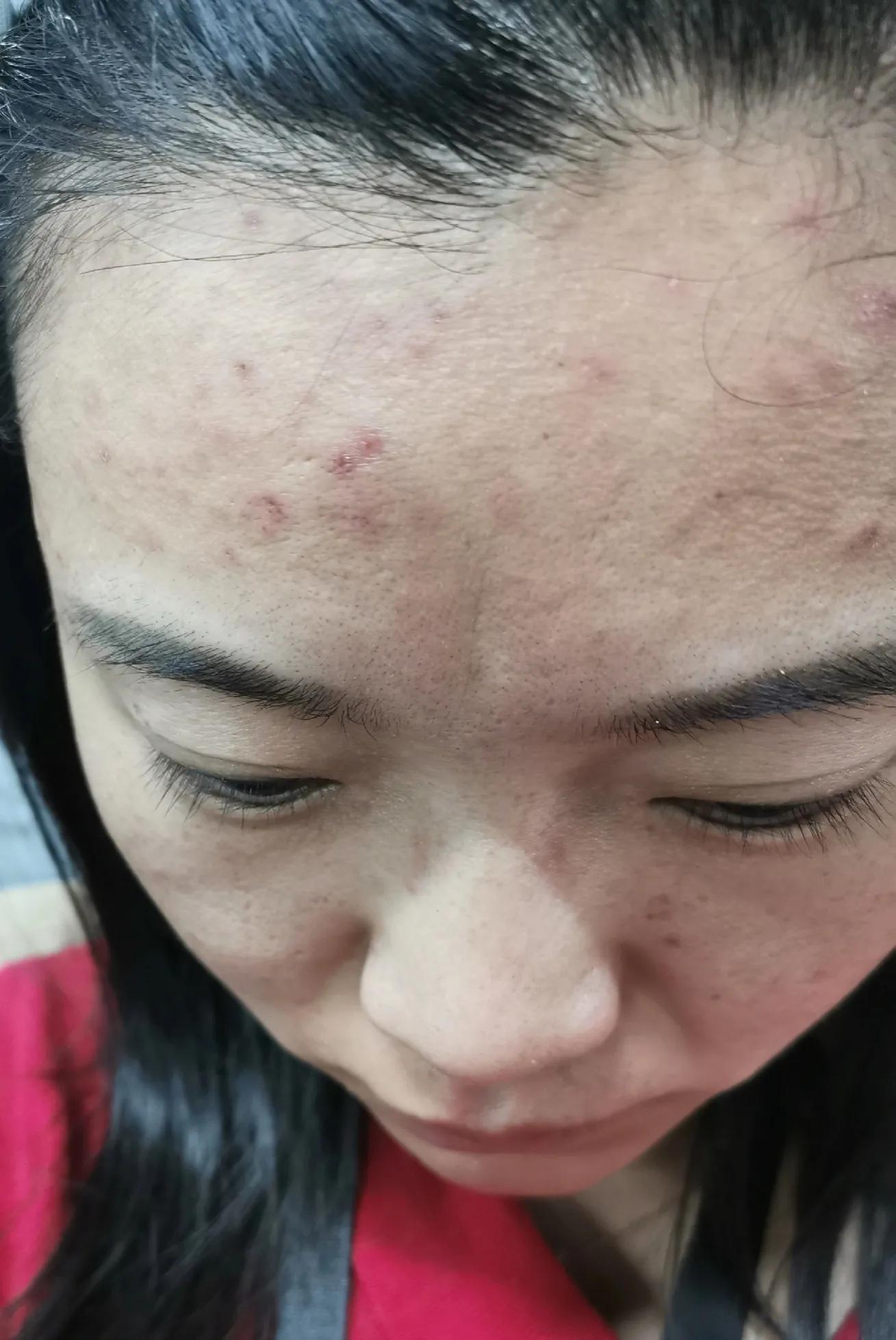 吐血总结祛痘膏,反反复复爆痘怎么都不管用