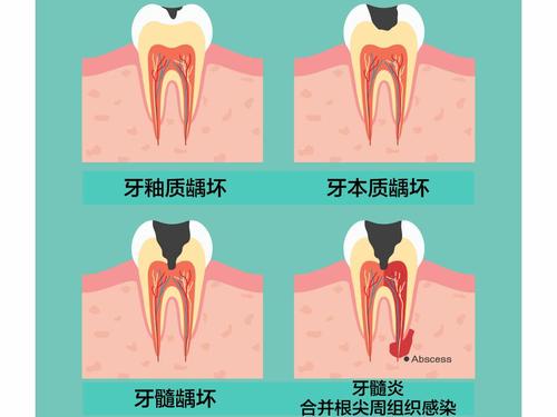 牙烂了一半医生不让拔,牙烂掉并不松动可以拔掉吗