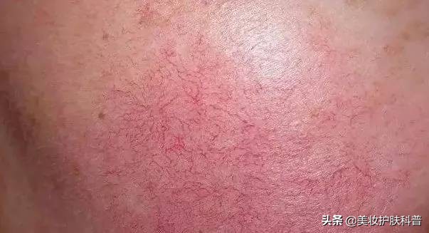 皮肤有血丝有点红怎么修复,红血丝养肤