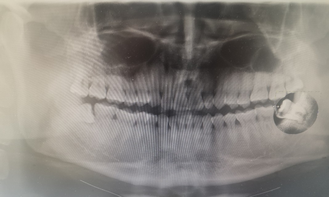 拔智齿过程中注意事项,拔智齿后注意事项和细节