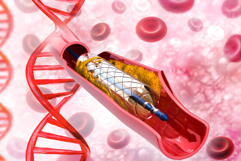 支架手术后再狭窄的几率高吗,支架手术两年后一天轻松走10000步