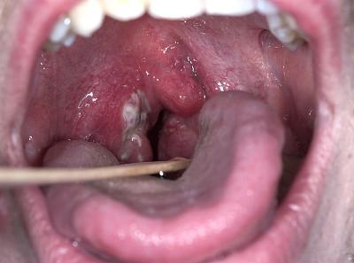 慢性咽炎又叫白领病,长期不治疗或致癌变?