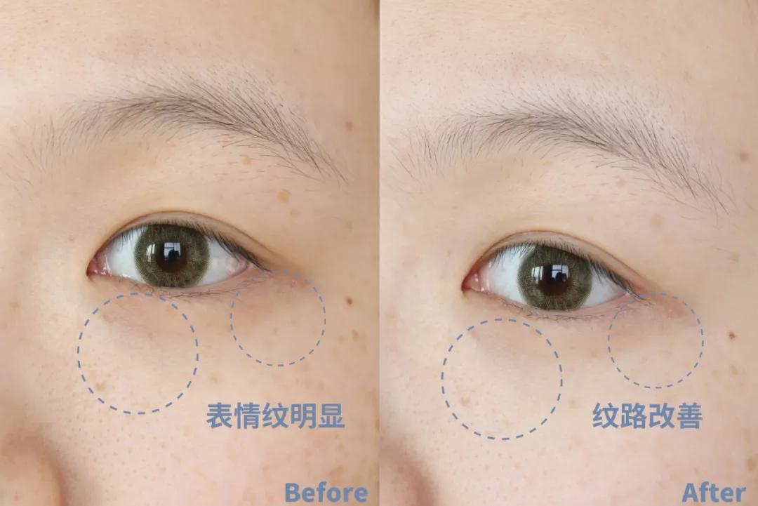 眼纹小熨斗,淡化眼纹小熨斗