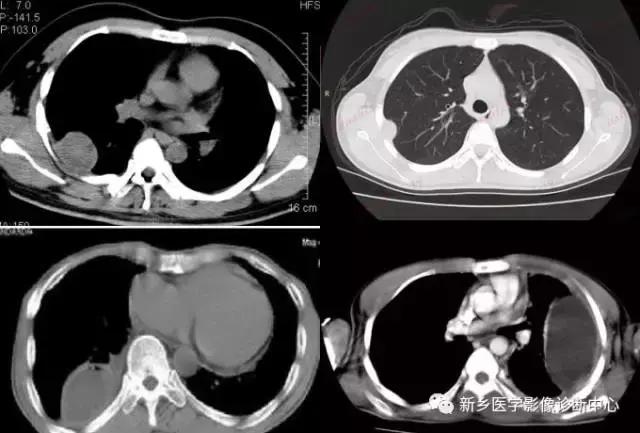 肺部有球形病灶怎么治疗,肺内多发结节诊断早期肺癌怎么办