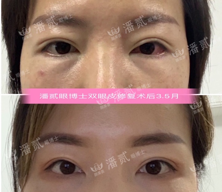 割双眼皮眼皮压下来会恢复吗,割双眼皮以后会松弛更快吗