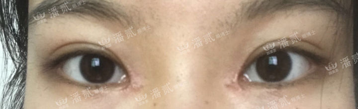 女孩眼部整形失败,内眼角整形失败