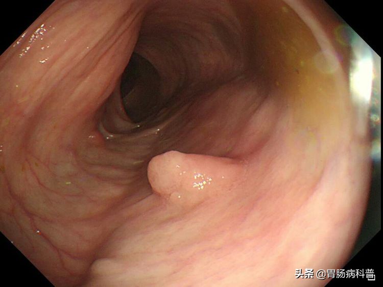 结肠癌会代代相传吗,结肠癌肝转移