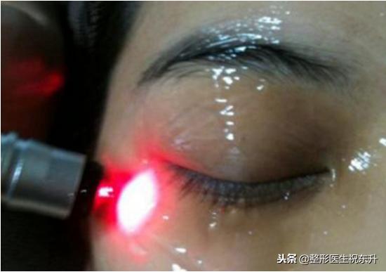 激光祛眼袋好还是手术去眼袋好,激光祛眼袋和手术哪个效果好