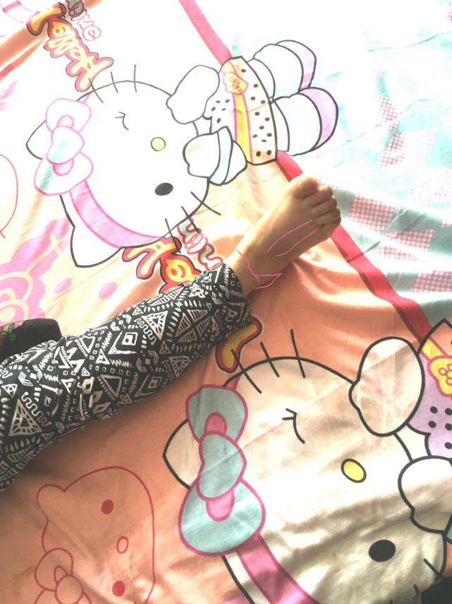 脚腕扭伤恢复后脚腕变粗活动受限,脚腕扭伤了怎么恢复最快