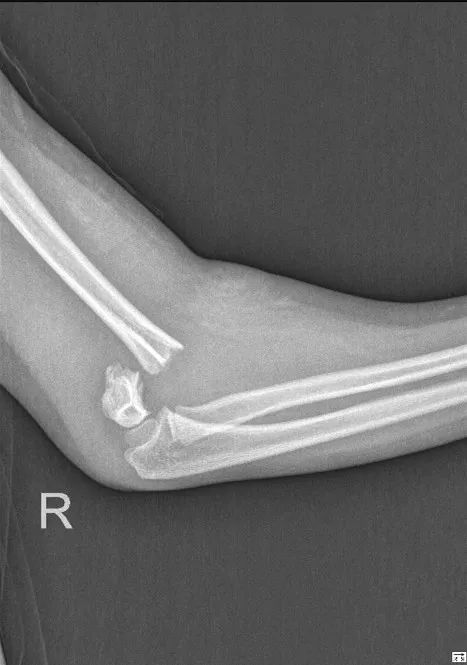 胳膊骨折三个月腿又骨折,孩子胳膊骨折好后还容易骨折么