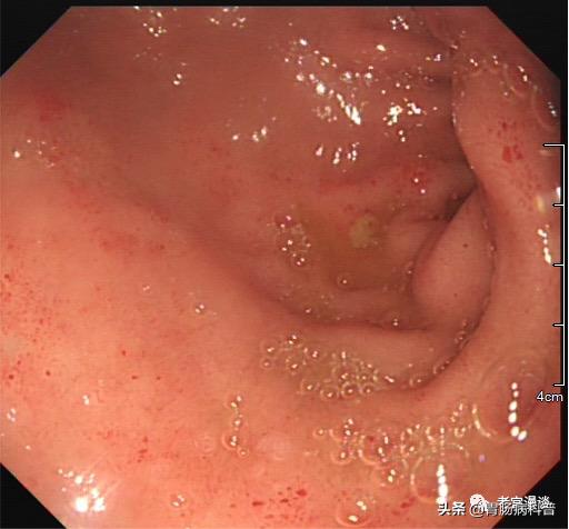 胃镜怎么做全过程,胃镜怎么做的全过程