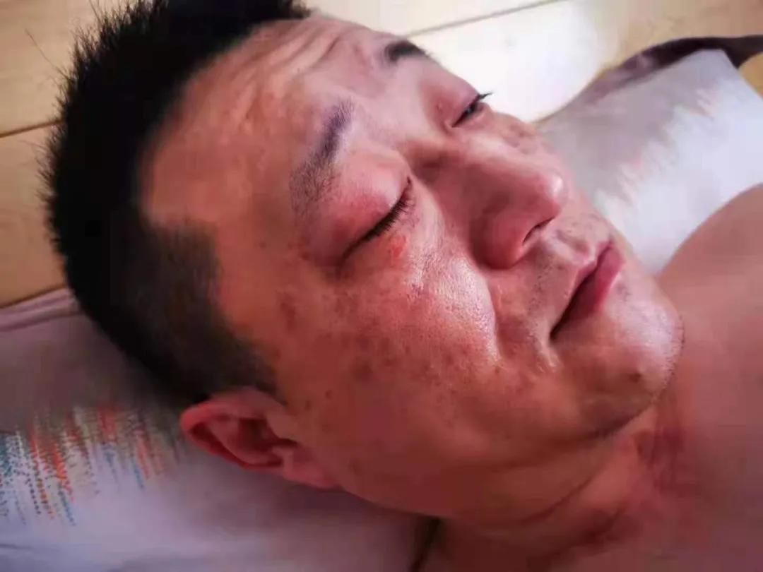 一声巨响，沸油扑向他的脸上、身上、眼睛里……这张照片瞬间让人破防！