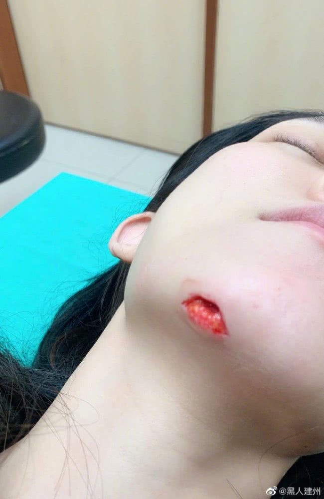 范玮琪深夜摔跤，下巴被摔一个洞，陈建州晒图吓坏网友