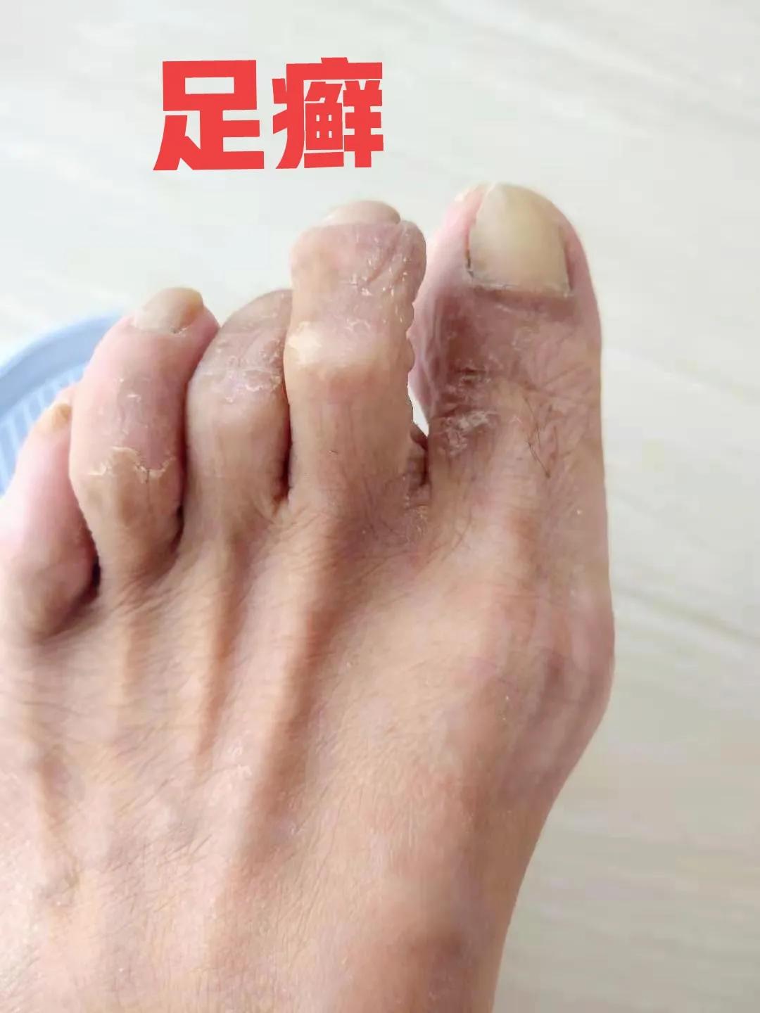 4种皮肤病最佳治疗方法,常见的手上皮肤病症状及治疗方法