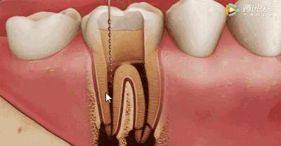根管治疗可怕,根管治疗很恐怖吗