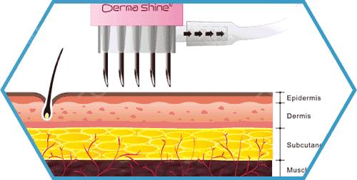 恐怖！网红直播水光针在家自己打，这操作你确定不是在逗我？